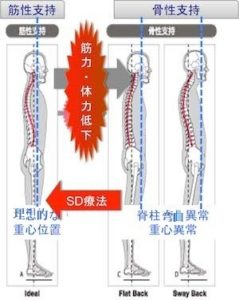 SD療法について