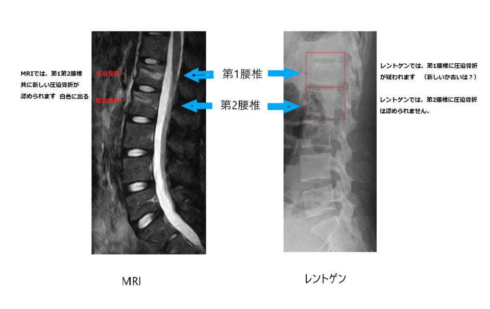 MRIレントゲン画像